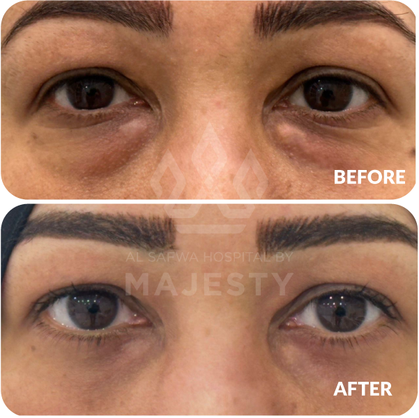 تجميل الجفون