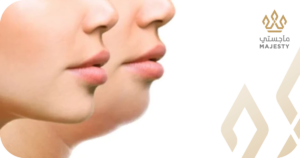 عملية شفط اللغلوغ في الرياض 2