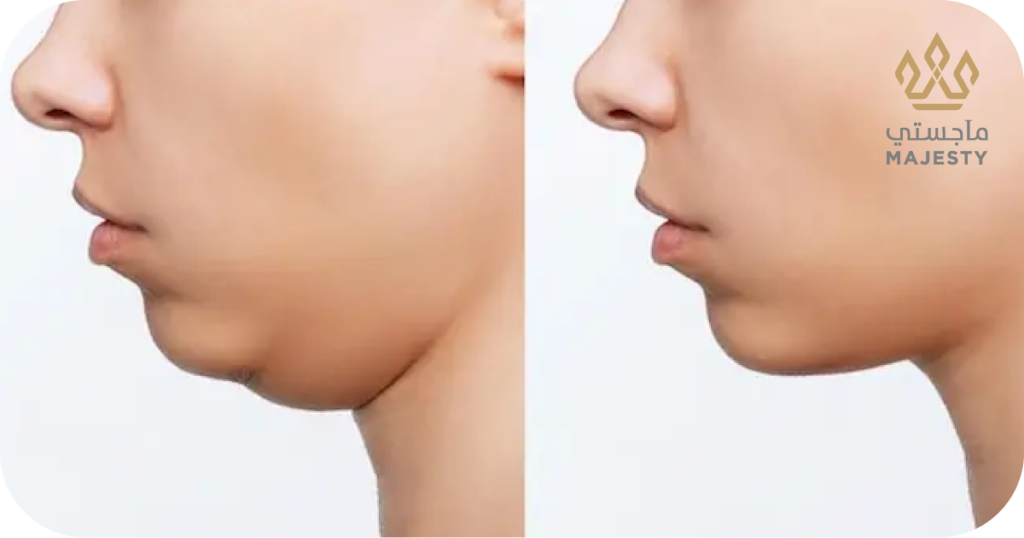 تكلفة عملية شفط اللغلوغ في الرياض 2026: الأسعار والعوامل المؤثرة