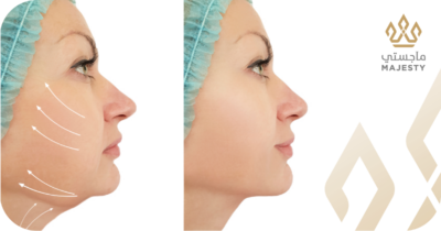 مراحل التعافي بعد عملية شفط اللغلوغ: دليلك يوماً بيوم