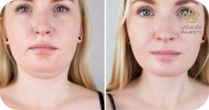 مراحل التعافي بعد عملية شفط اللغلوغ2