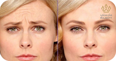 بوتكس الجبهة في الرياض: كيف تتخلصين من الخطوط التعبيرية بأمان؟
