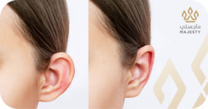 عملية تجميل الأذن البارزة