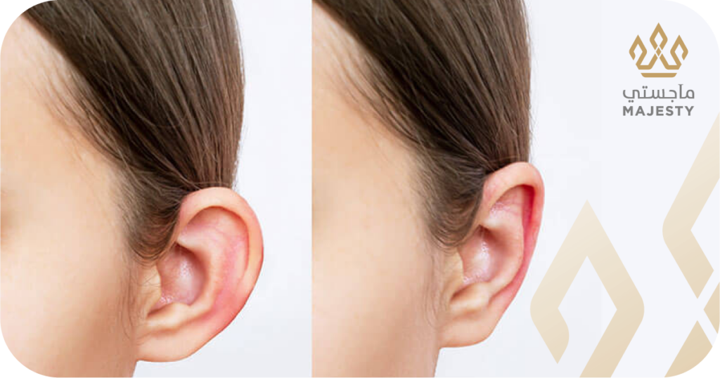 عملية تجميل الأذن للأطفال في الرياض: متى وكيف نحمي أطفالنا؟