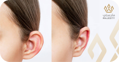 عملية تجميل الأذن للأطفال في الرياض: متى وكيف نحمي أطفالنا؟