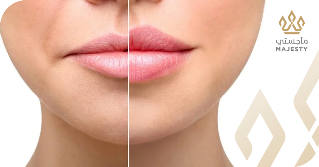 فيلر الشفايف في الرياض: دليلك لاختيار الرسمة المثالية (روسي أم كلاسيك؟)