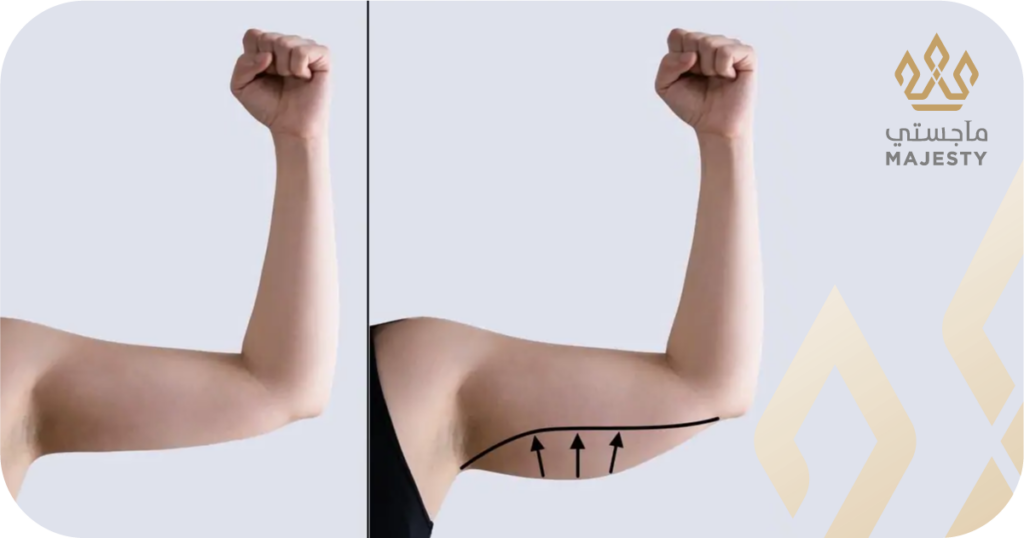 عملية شد الذراعين في الرياض: دليلك الكامل للتخلص من ترهل الزنود