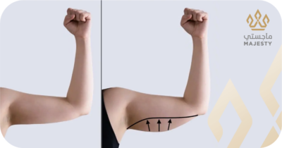 عملية شد الذراعين في الرياض: دليلك الكامل للتخلص من ترهل الزنود