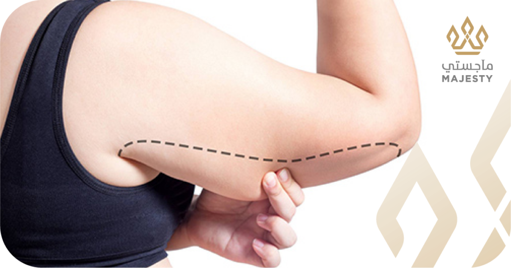شفط دهون الذراعين بالفيزر في الرياض: تخلصي من الامتلاء المزعج
