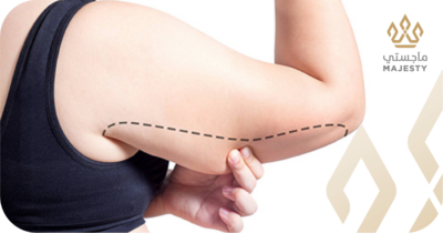 شفط دهون الذراعين بالفيزر في الرياض: تخلصي من الامتلاء المزعج