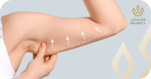 شفط دهون الذراعين