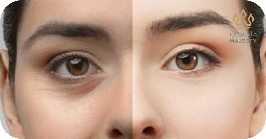 تكلفة عملية قص الجفون في الرياض 2026: الأسعار والعروض