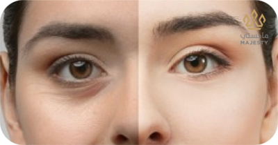 تكلفة عملية قص الجفون في الرياض 2026: الأسعار والعروض