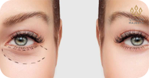 تكلفة عملية قص الجفون