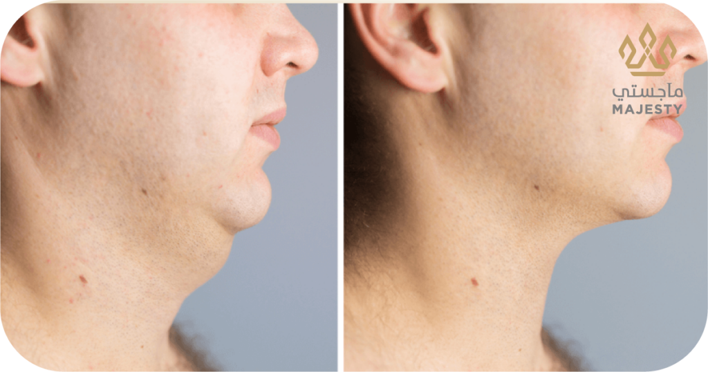 إزالة اللغلوغ بدون جراحة في الرياض: الخيارات والنتائج الحقيقية