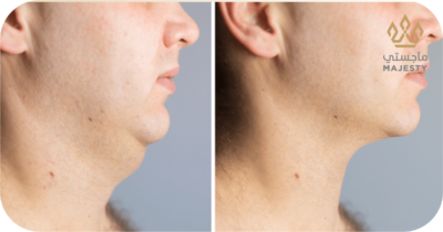 إزالة اللغلوغ بدون جراحة في الرياض: الخيارات والنتائج الحقيقية