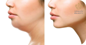 إزالة اللغلوغ بدون جراحة