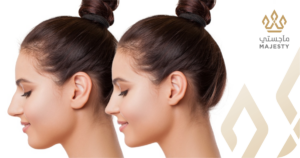 تجميل الأذن بدون جراحة