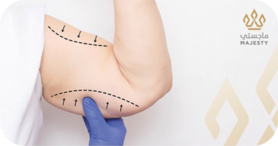 التعافي وشكل الندبات بعد شد الذراعين: دليلك للوصول للنتيجة النهائية