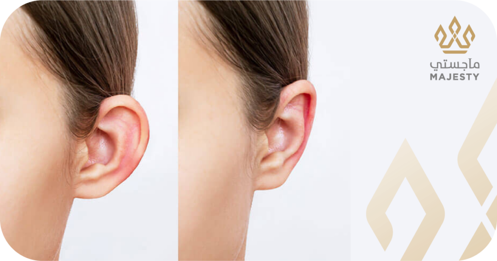 تصحيح شكل الأذن في الرياض: عندما يكون الحل أبعد من مجرد البروز
