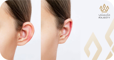 تصحيح شكل الأذن في الرياض: عندما يكون الحل أبعد من مجرد البروز