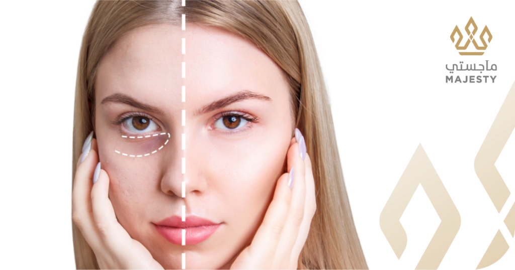 فيلر تحت العين في الرياض: الحل الجذري للتجاويف ونظرة الإرهاق