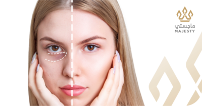 فيلر تحت العين في الرياض: الحل الجذري للتجاويف ونظرة الإرهاق