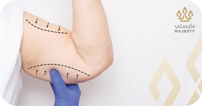 تجربتي مع عملية شد الذراعين: كيف تخلصت من ترهل الزنود للأبد؟