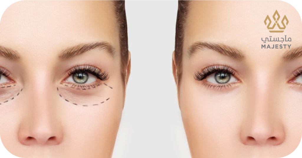 تجربتي مع عملية قص الجفون: وداعاً للنظرة المتعبة والجفن المبطن