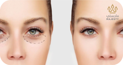 تجربتي مع عملية قص الجفون: وداعاً للنظرة المتعبة والجفن المبطن