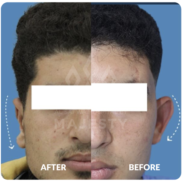 تجميل الأذن البارزة