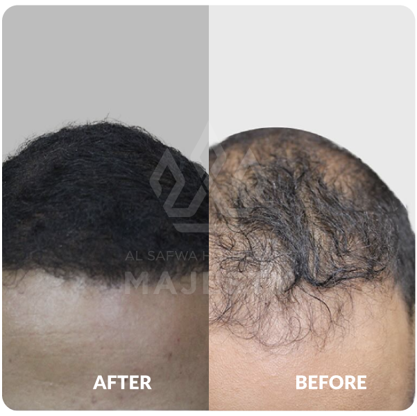 زراعة الشعر