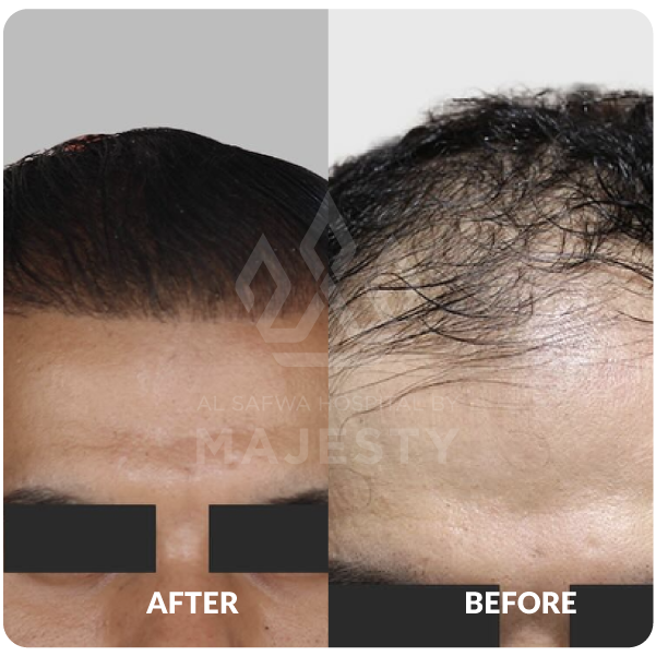 زراعة الشعر