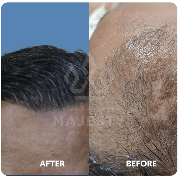 زراعة الشعر