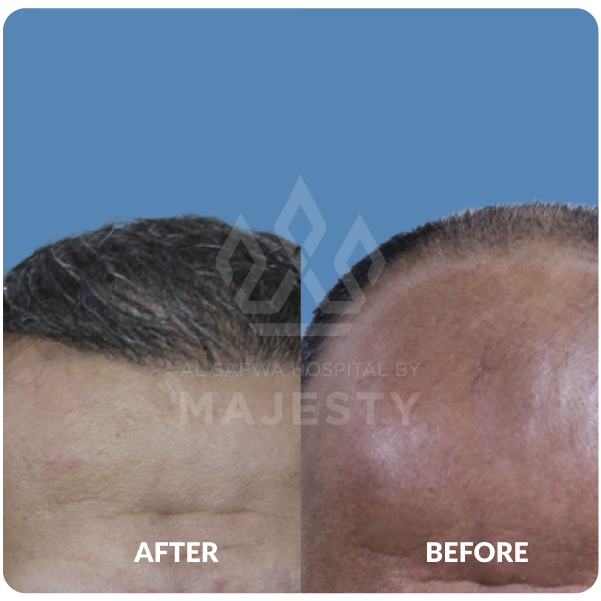 زراعة الشعر