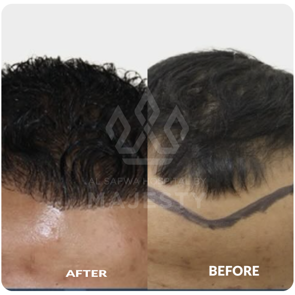 زراعة الشعر