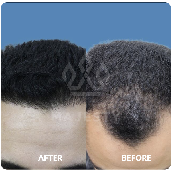 زراعة الشعر