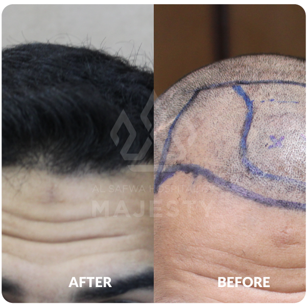 زراعة الشعر