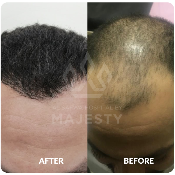 زراعة الشعر