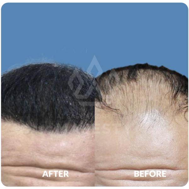 زراعة الشعر